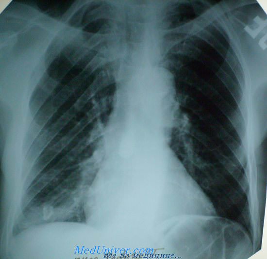 Фотография: Рентгеновский снимок легких с картиной перенесенного туберкулеза