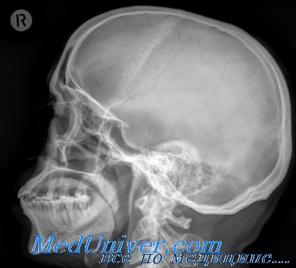 рентгенография основной пазухи носа