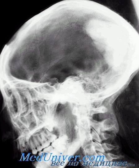рентгенография черепа