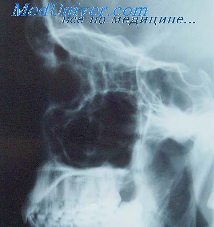 рентгенография решетчатой кости
