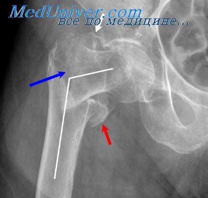Частые переломы трубчатых костей thumbnail