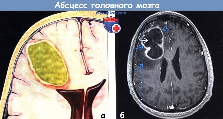 Абсцесс головного мозга на МРТ