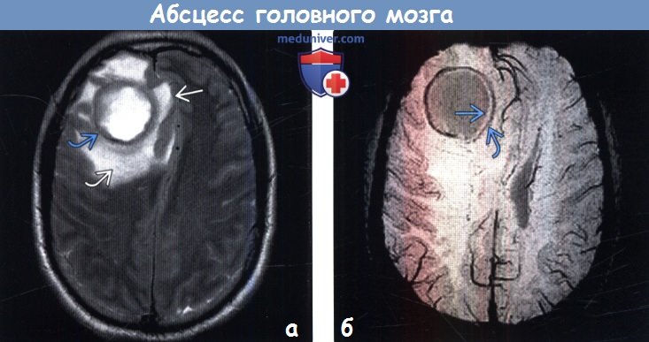 Абсцесс головного мозга симптомы мрт thumbnail