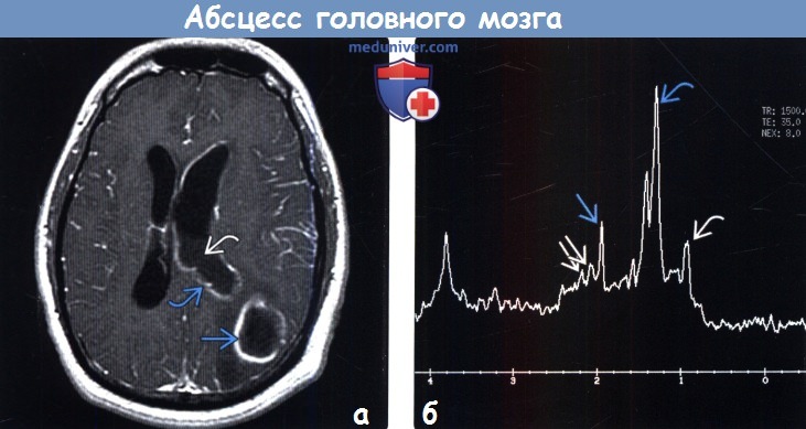 Абсцесс головного мозга на МРТ, спектроскопия