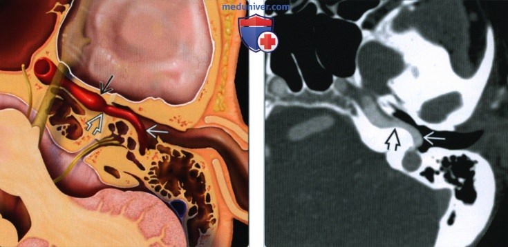 Аберрантная внутренняя сонная артерия (АбВСА) - лучевая диагностика
