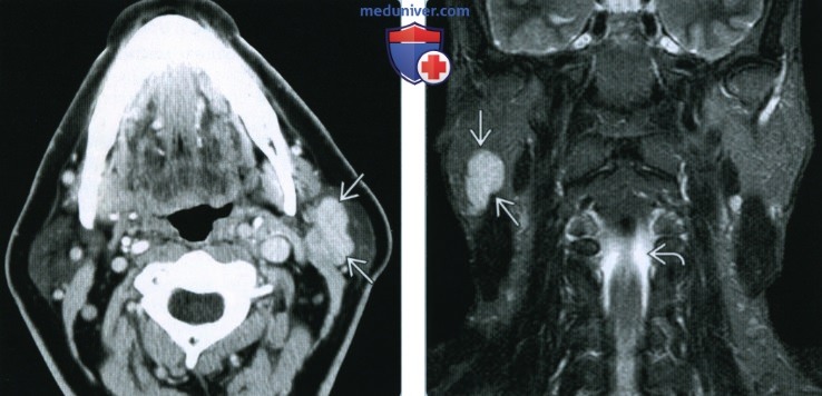 Ацинарноклеточный рак околоушной железы - лучевая диагностика