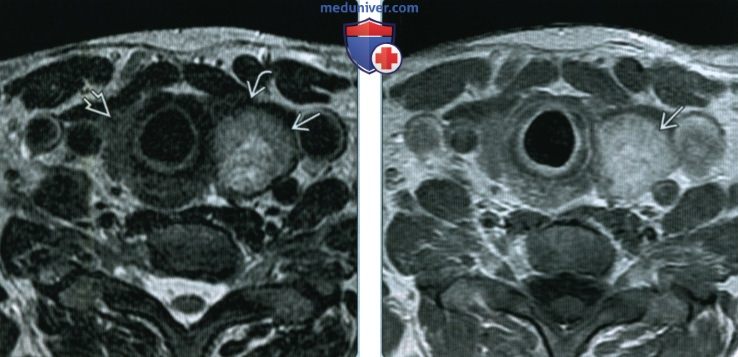 Аденома щитовидной железы - лучевая диагностика