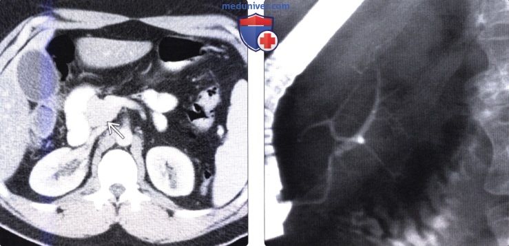 Лучевая диагностика агенезии дорсальных отделов поджелудочной железы