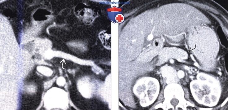 Лучевая диагностика агенезии дорсальных отделов поджелудочной железы