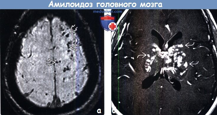 Амилоидоз головного мозга на МРТ