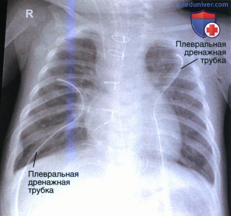 Советы по анализу рентгенограммы органов грудной клетки (ОГК)
