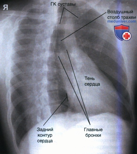 Укладка при рентгенограмме органов грудной клетки (ОГК) в косой задне-передней проекции (ЗП проекции)