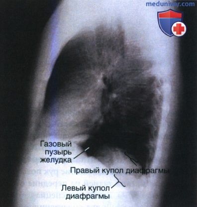 Рекомендации по анализу рентгенограммы органов грудной клетки в боковой проекции (левой)