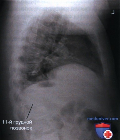 Рекомендации по анализу рентгенограммы органов грудной клетки в боковой проекции (левой)