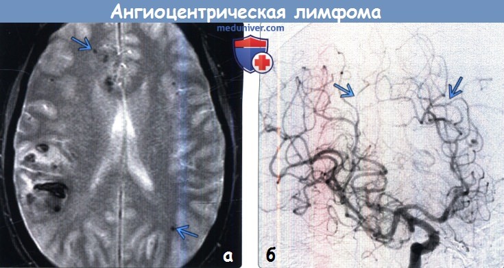 Ангиоцентрическая лимфома головного мозга на МРТ