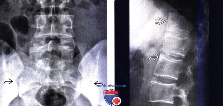 Рентгенограмма анкилозирующего спондилита