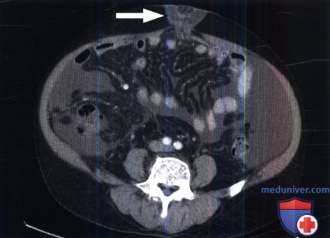 КТ, МРТ при грыже (внутрибрюшной, брюшной стенки, тазовой, паховой, диафрагмальной)