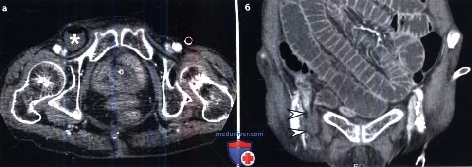 Компьютерная томография брюшной полости при грыжах thumbnail