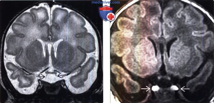 Аномалии развития гипофиза на МРТ головного мозга
