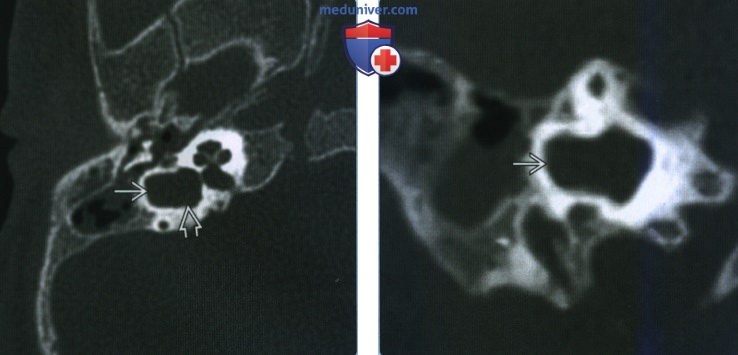 Аномальный шаровидный полукружный канал-преддверие - лучевая диагностика