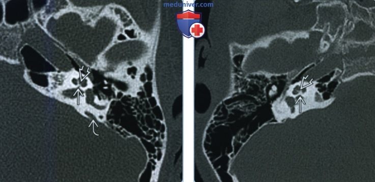 Аплазия-гипоплазия улиткового нерва и канала улиткового нерва - лучевая диагностика