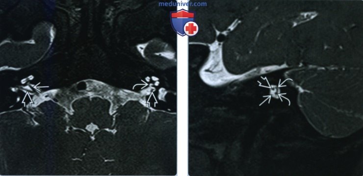 Аплазия-гипоплазия улиткового нерва и канала улиткового нерва - лучевая диагностика