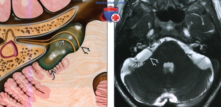 Арахноидальная киста мостомозжечкового угла (ММУ) и внутреннего слухового канала (ВСК) - лучевая диагностика