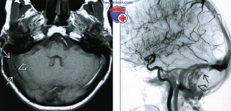 Аберрантные арахноидальные грануляции синусов твердой мозговой оболочки - лучевая диагностика
