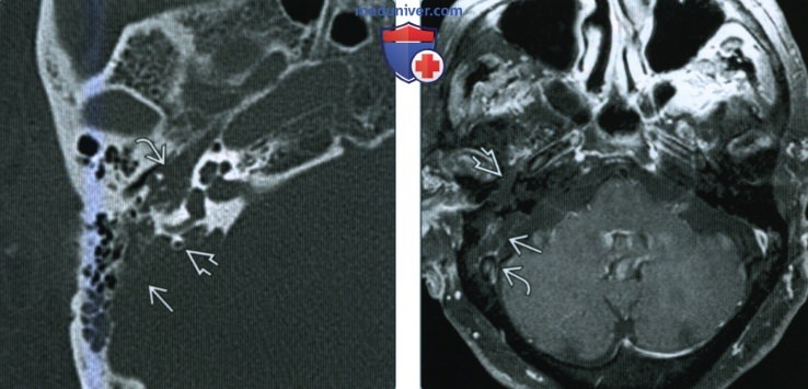 Арахноидальные грануляции височной кости - лучевая диагностика