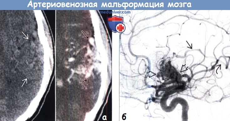 Артериовенозная мальформация головного мозга на КТ, ангиограмме