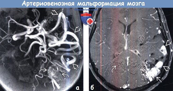 Артериовенозная мальформация головного мозга на МРТ, ангиограмме