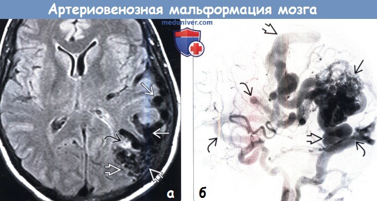 Артериовенозная мальформация головного мозга на МРТ, ангиограмме