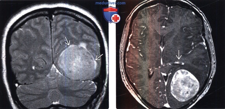 Атипичная и злокачественная менингиома на МРТ