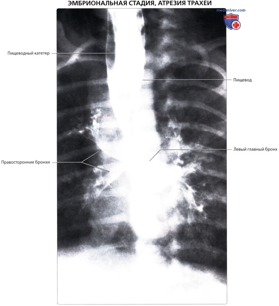 Рентгенограмма при атрезии трахеи у новорожденного