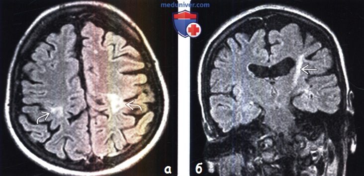 Боковой амиотрофический склероз на МРТ головного мозга