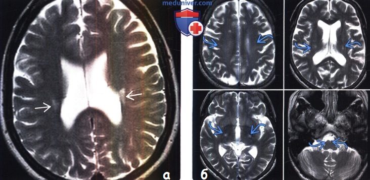 Боковой амиотрофический склероз на МРТ головного мозга