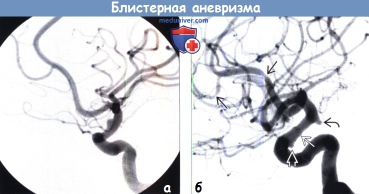 Блистерная аневризма головного мозга на КТ, ангиограмме