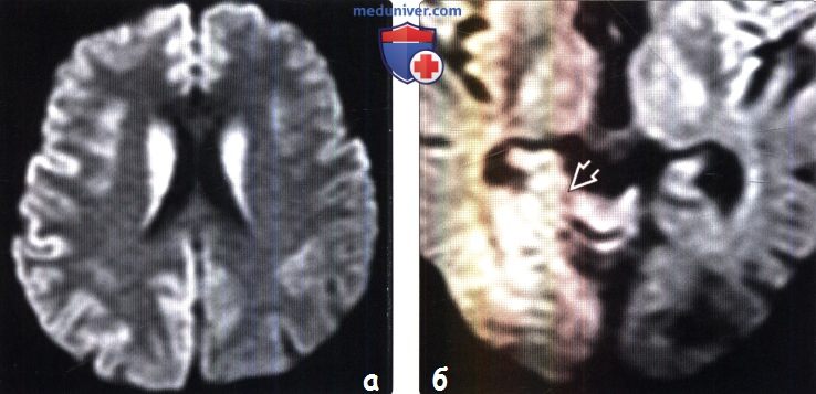 Болезнь Крейтцфельдта-Якоба на МРТ головного мозга
