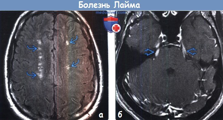 Болезнь Лайма головного мозга на МРТ