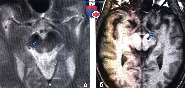 Болезнь Паркинсона на МРТ головного мозга
