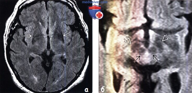 Болезнь Паркинсона на МРТ головного мозга