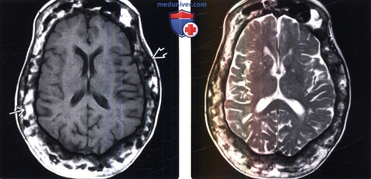 Болезнь Педжета головы на МРТ