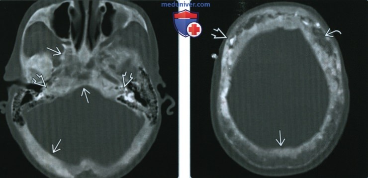 Болезнь Педжета основания черепа - лучевая диагностика