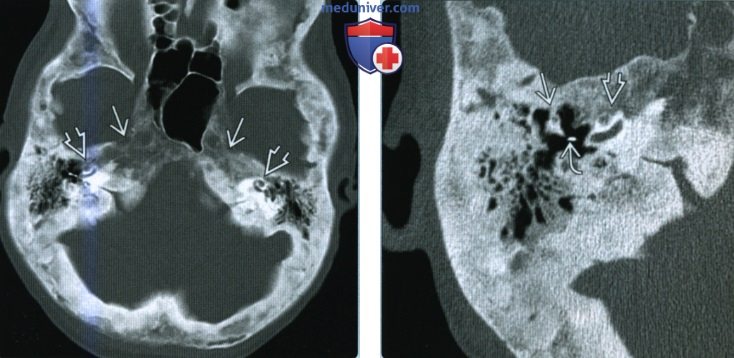 Болезнь Педжета височной кости - лучевая диагностика