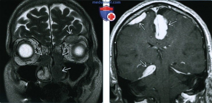 Синусовый гистиоцитоз (болезнь Розаи-Дорфмана) головы и шеи - лучевая диагностика