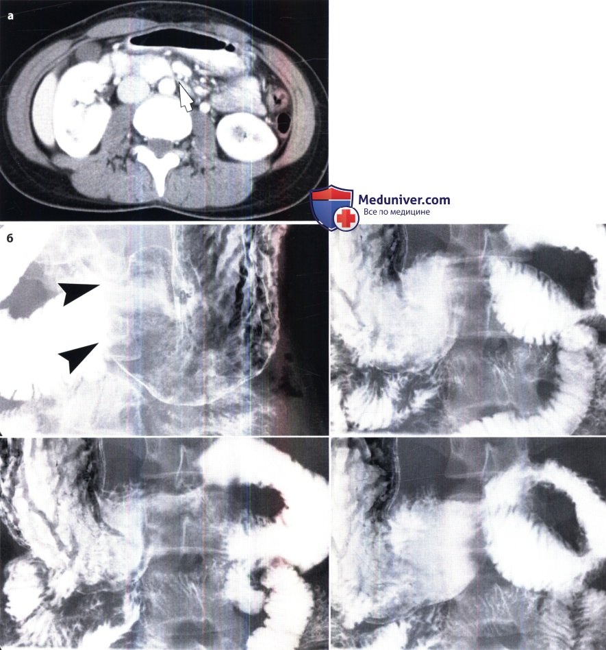 Рентгенограмма, КТ при синдроме верхней мезентериальной артерии (ВМА)