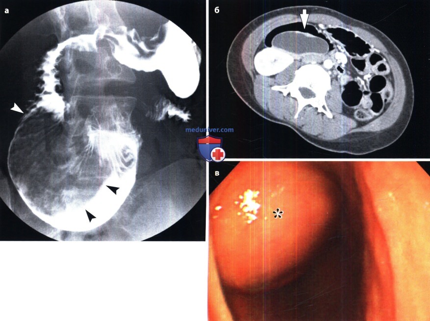 Рентгенограмма, КТ, УЗИ, ФГДС при дупликационной кисте двенадцатиперстной кишки