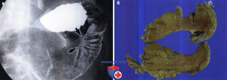 Рентгенограмма, КТ при язве желудка и двенадцатиперстной кишки