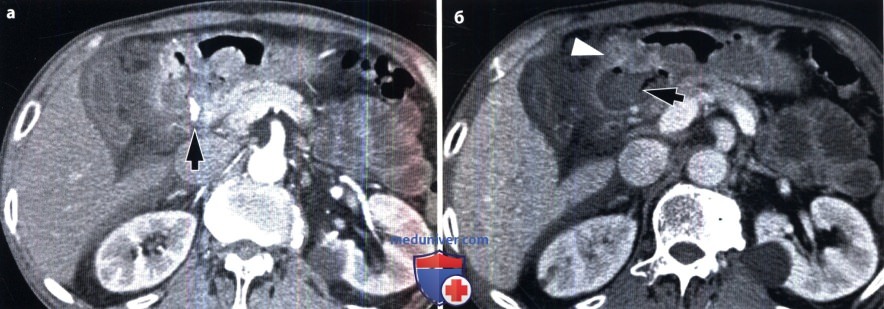 Рентгенограмма, КТ при язве желудка и двенадцатиперстной кишки