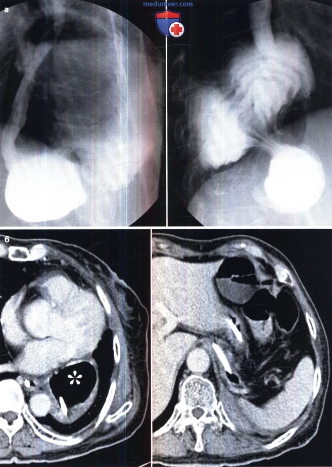 Рентгенограмма, КТ при завороте желудка